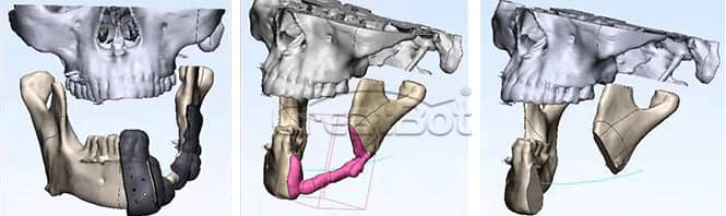 lower jawbone PEEK implant 06